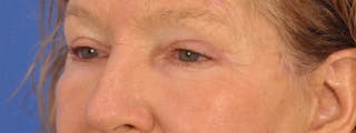 Blepharoplasty Before & After Gallery - Patient 100117 - Image 8