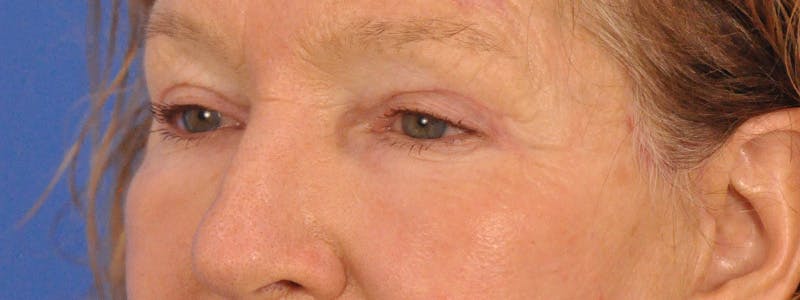 Blepharoplasty Before & After Gallery - Patient 100117 - Image 8