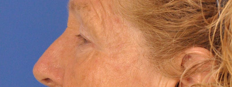 Blepharoplasty Before & After Gallery - Patient 100117 - Image 9