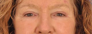 Blepharoplasty Before & After Gallery - Patient 100117 - Image 2