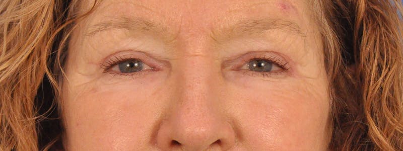 Blepharoplasty Before & After Gallery - Patient 100117 - Image 2