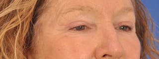 Blepharoplasty Before & After Gallery - Patient 100117 - Image 4