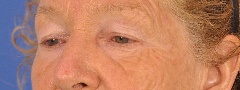 Blepharoplasty Before & After Gallery - Patient 100117 - Image 7
