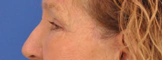 Blepharoplasty Before & After Gallery - Patient 100117 - Image 10
