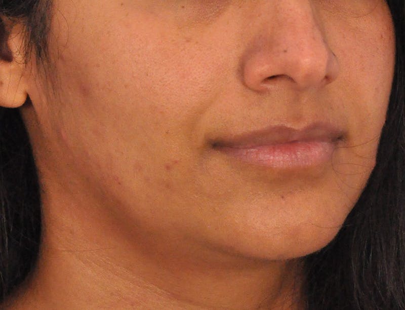 Lip Lift Before & After Gallery - Patient 424833 - Image 3