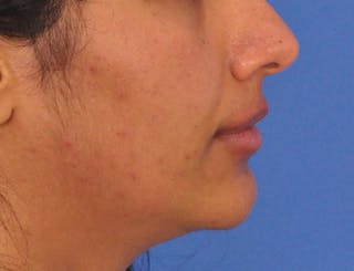 Lip Lift Before & After Gallery - Patient 424833 - Image 6