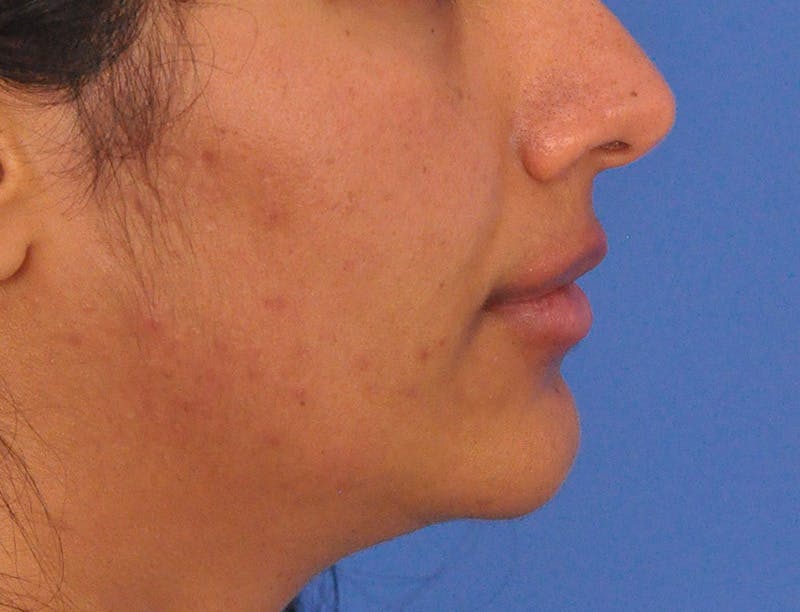 Lip Lift Before & After Gallery - Patient 424833 - Image 6
