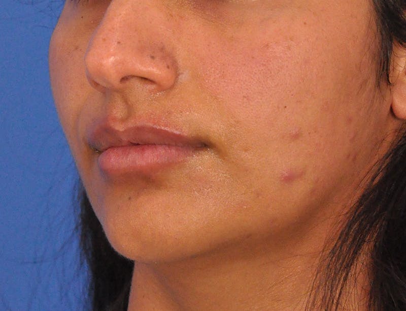 Lip Lift Before & After Gallery - Patient 424833 - Image 8