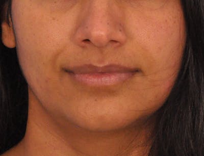 Lip Lift Before & After Gallery - Patient 424833 - Image 1