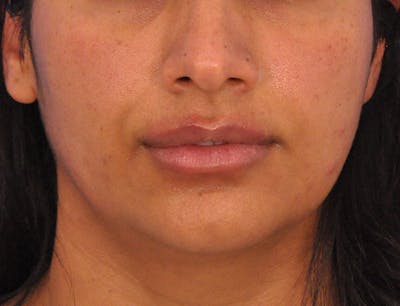 Lip Filler Before & After Gallery - Patient 248569 - Image 2