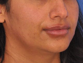 Lip Lift Before & After Gallery - Patient 424833 - Image 4