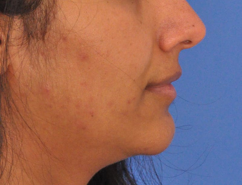 Lip Lift Before & After Gallery - Patient 424833 - Image 5