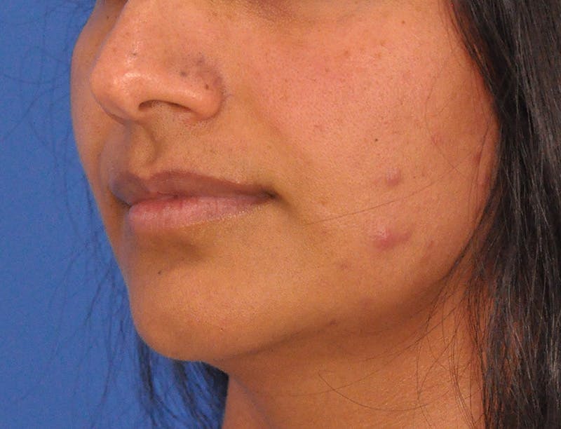 Lip Lift Before & After Gallery - Patient 424833 - Image 7
