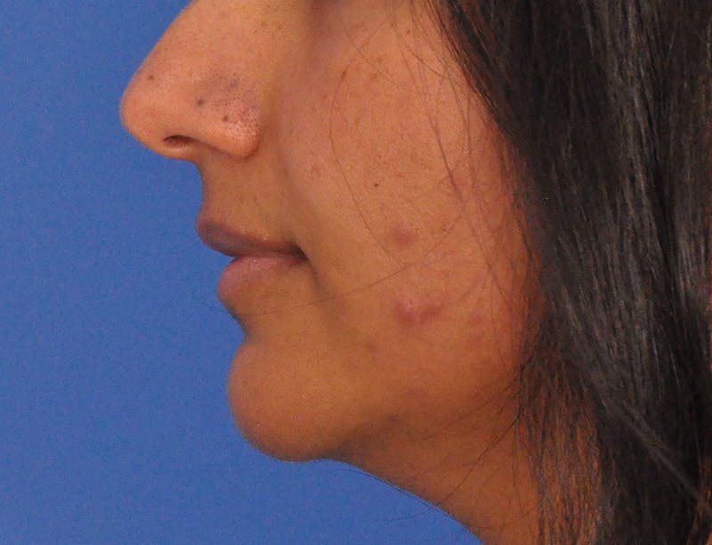 Lip Lift Before & After Gallery - Patient 424833 - Image 9