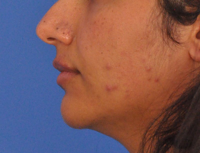 Lip Lift Before & After Gallery - Patient 424833 - Image 10
