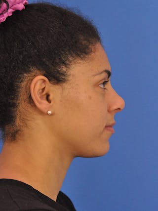 BBL & Moxi Before & After Gallery - Patient 281214 - Image 6