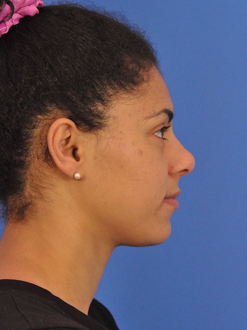 BBL & Moxi Before & After Gallery - Patient 281214 - Image 6