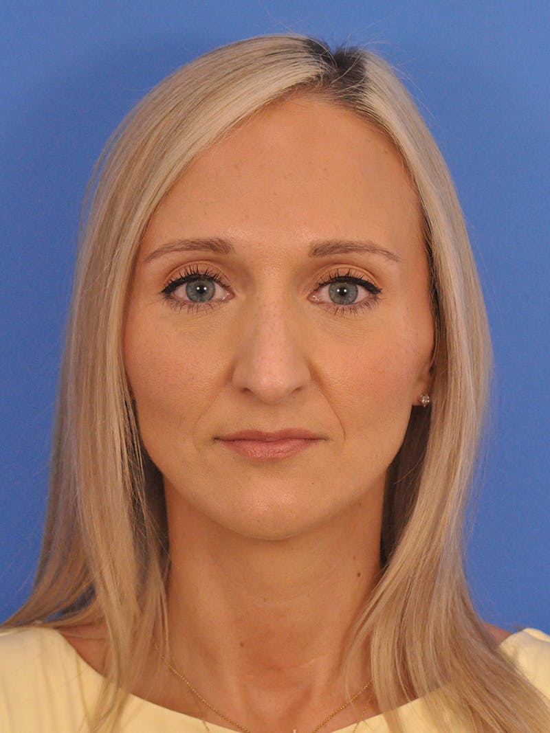 Rhinoplasty Before & After Gallery - Patient 168361 - Image 5