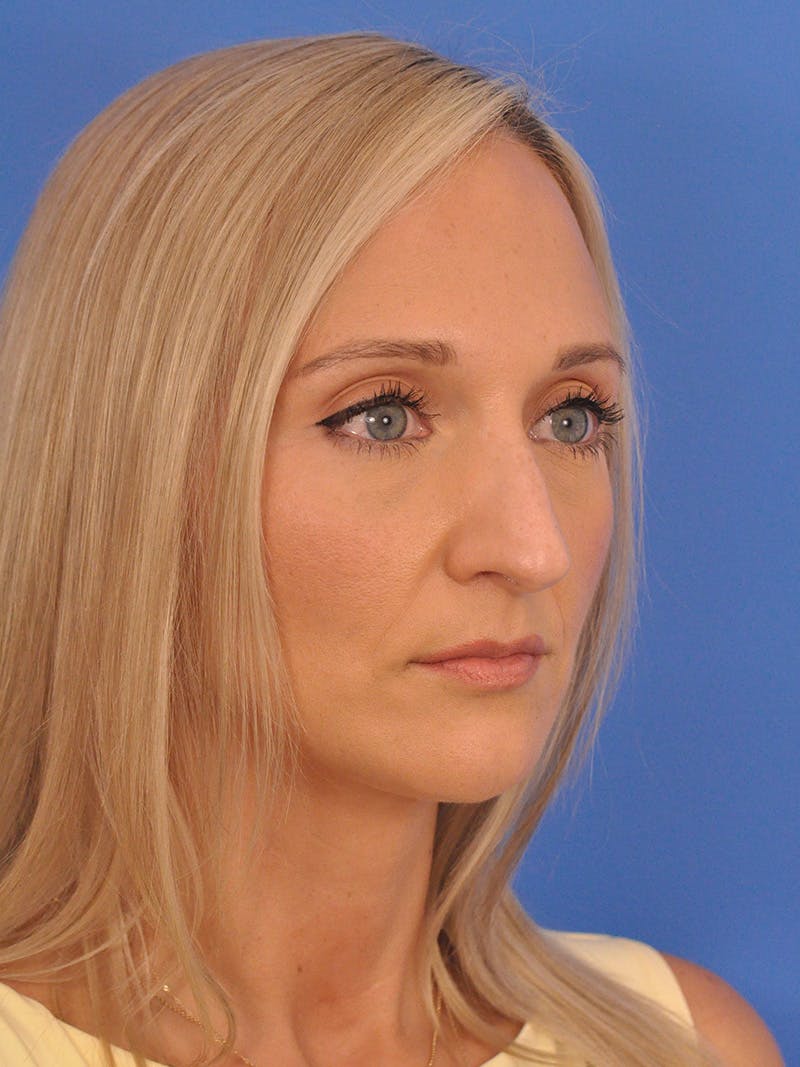 Rhinoplasty Before & After Gallery - Patient 168361 - Image 3