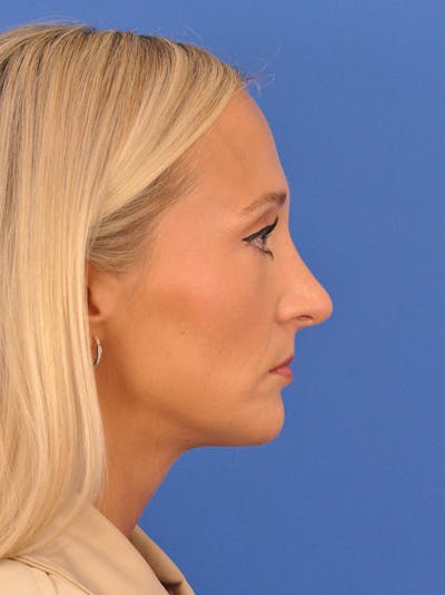 Rhinoplasty Before & After Gallery - Patient 168361 - Image 2