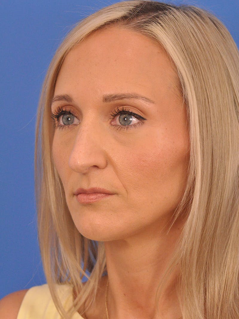 Rhinoplasty Before & After Gallery - Patient 168361 - Image 7