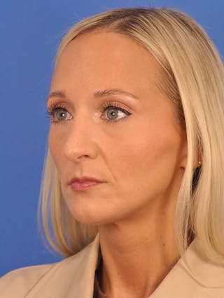 Rhinoplasty Before & After Gallery - Patient 168361 - Image 8