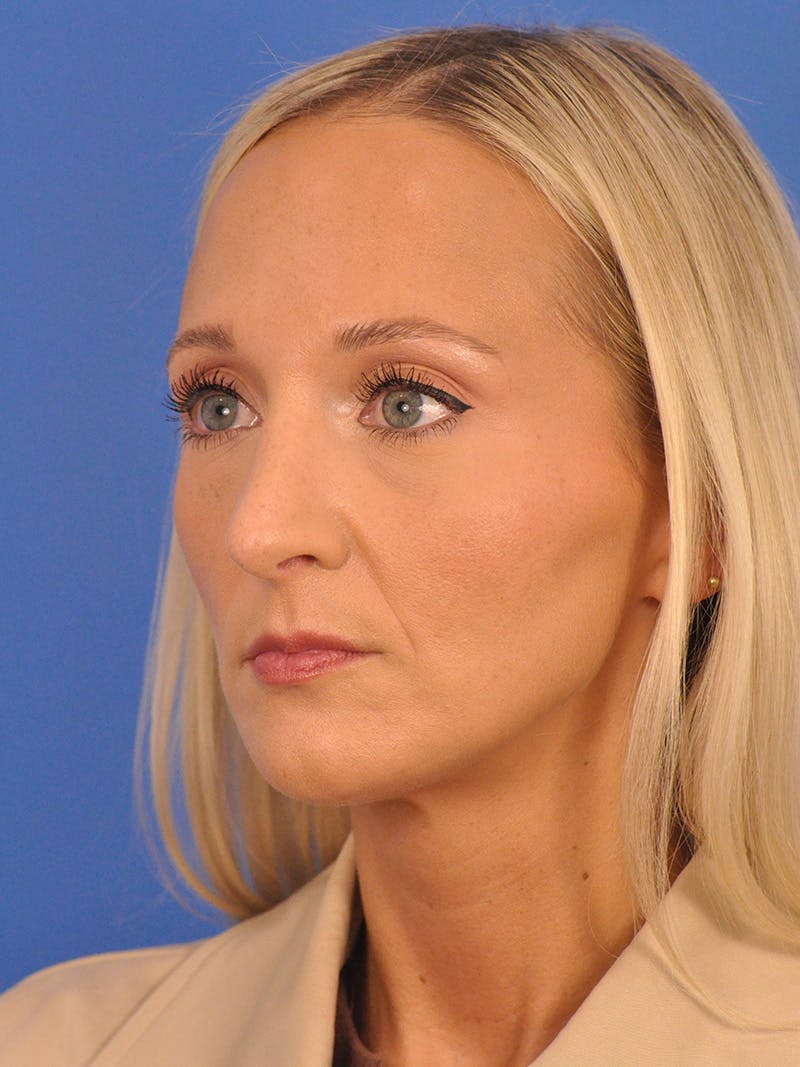 Rhinoplasty Before & After Gallery - Patient 168361 - Image 8