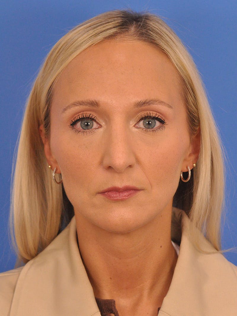Rhinoplasty Before & After Gallery - Patient 168361 - Image 6