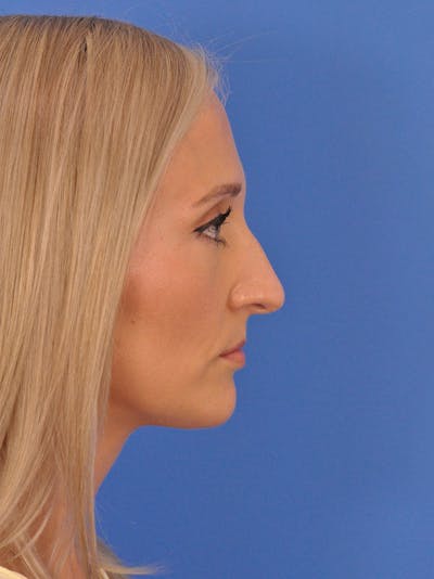 Rhinoplasty Before & After Gallery - Patient 168361 - Image 1