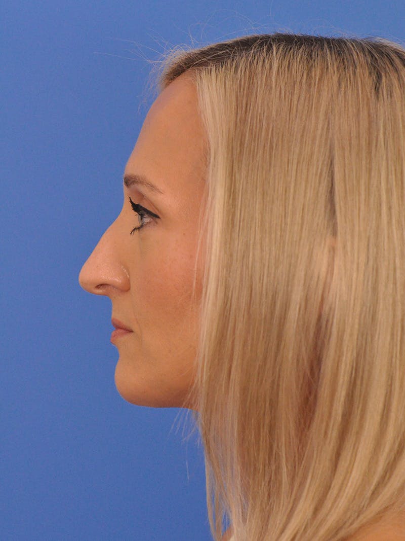 Rhinoplasty Before & After Gallery - Patient 168361 - Image 9