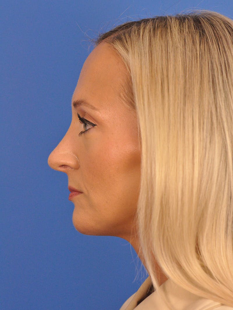 Rhinoplasty Before & After Gallery - Patient 168361 - Image 10