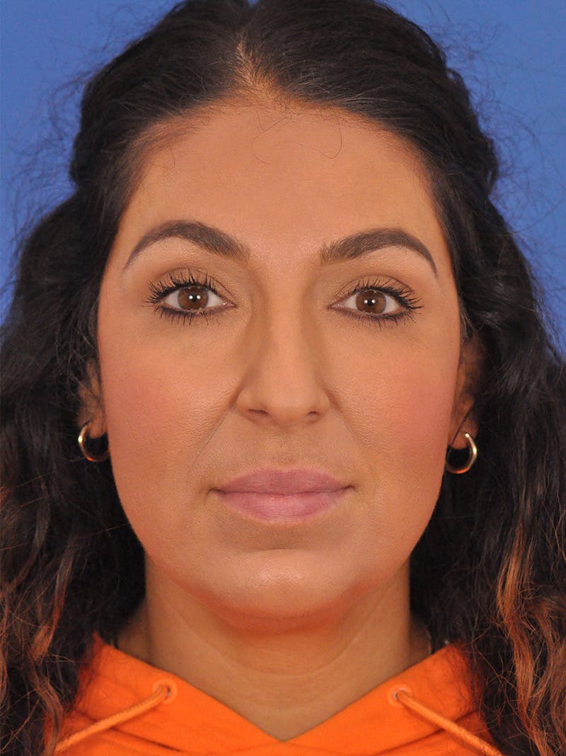 Rhinoplasty Before & After Gallery - Patient 207518 - Image 5