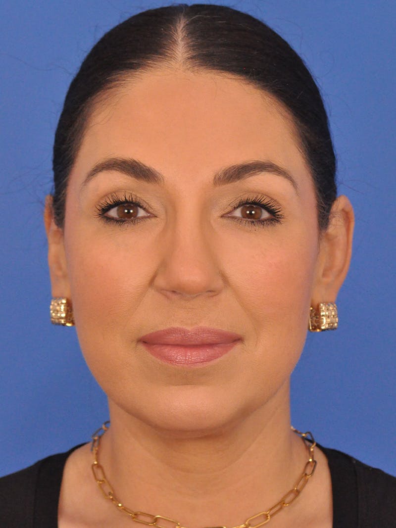 Rhinoplasty Before & After Gallery - Patient 207518 - Image 6