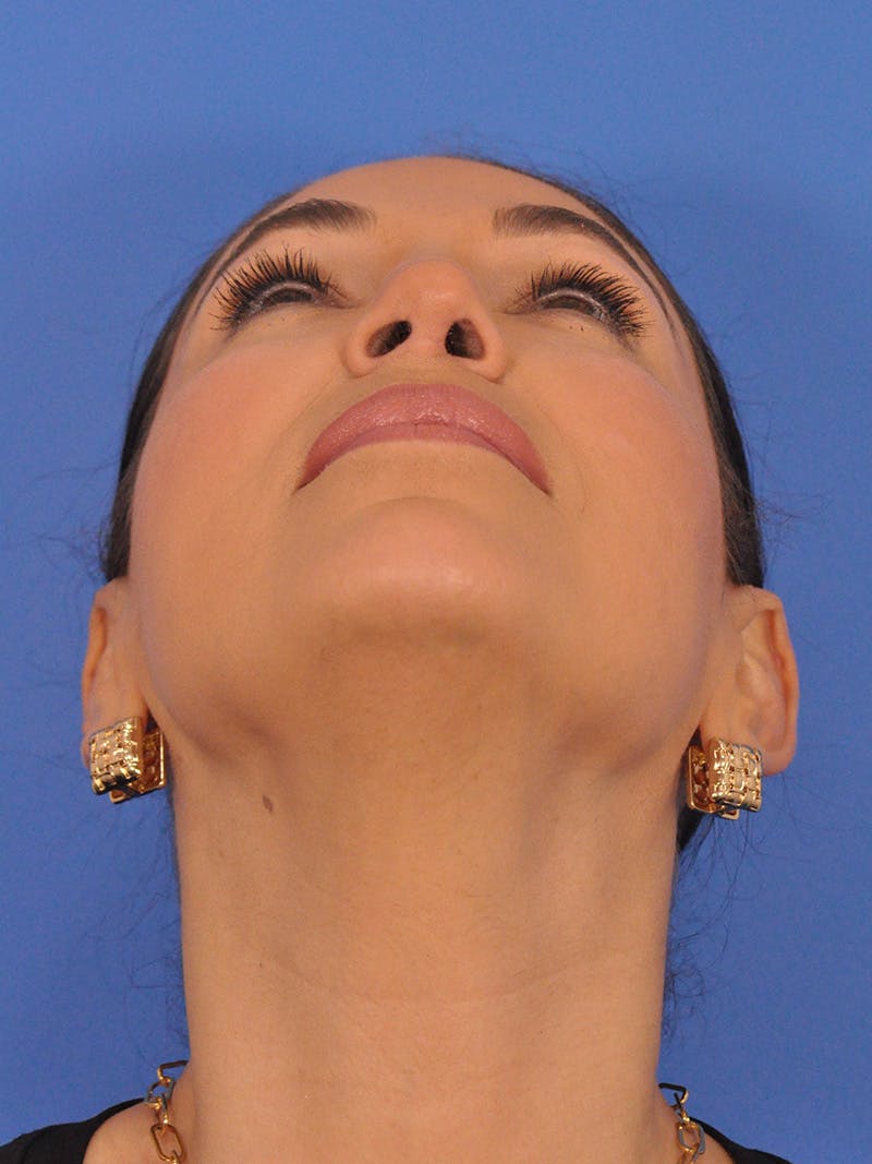 Rhinoplasty Before & After Gallery - Patient 207518 - Image 10