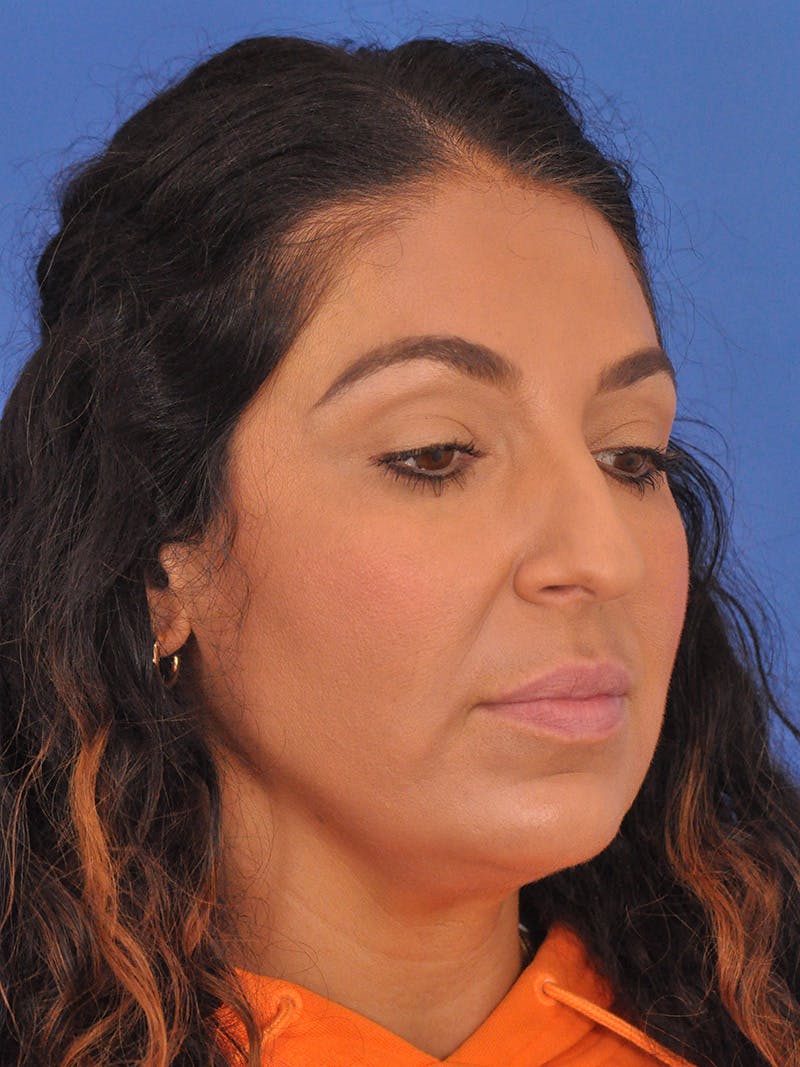 Rhinoplasty Before & After Gallery - Patient 207518 - Image 3