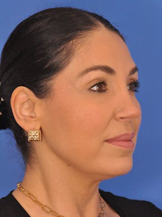 Rhinoplasty Before & After Gallery - Patient 207518 - Image 4