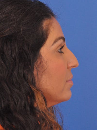 Rhinoplasty Before & After Gallery - Patient 207518 - Image 1