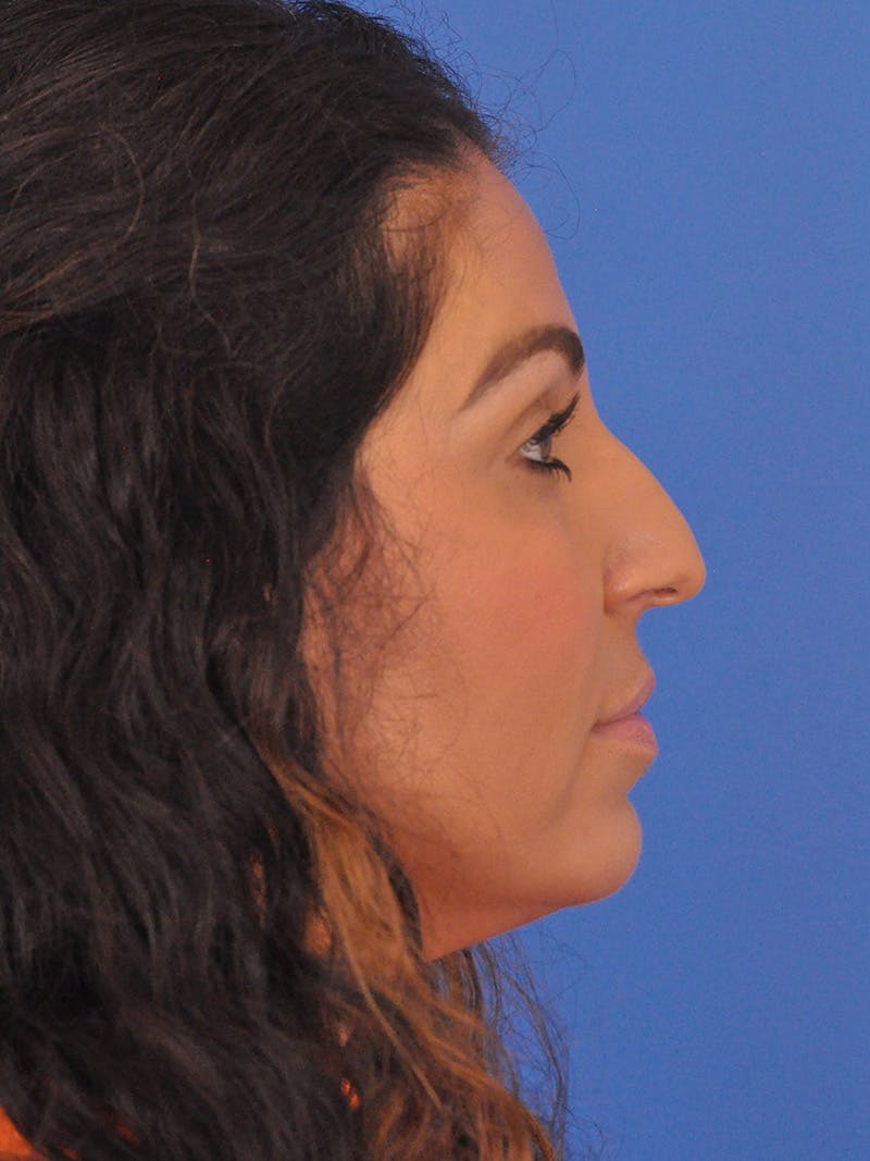 Rhinoplasty Before & After Gallery - Patient 207518 - Image 1
