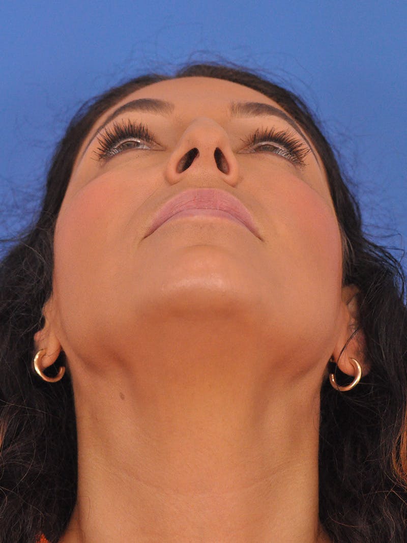 Rhinoplasty Before & After Gallery - Patient 207518 - Image 9