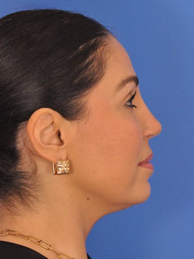 Rhinoplasty Before & After Gallery - Patient 207518 - Image 2