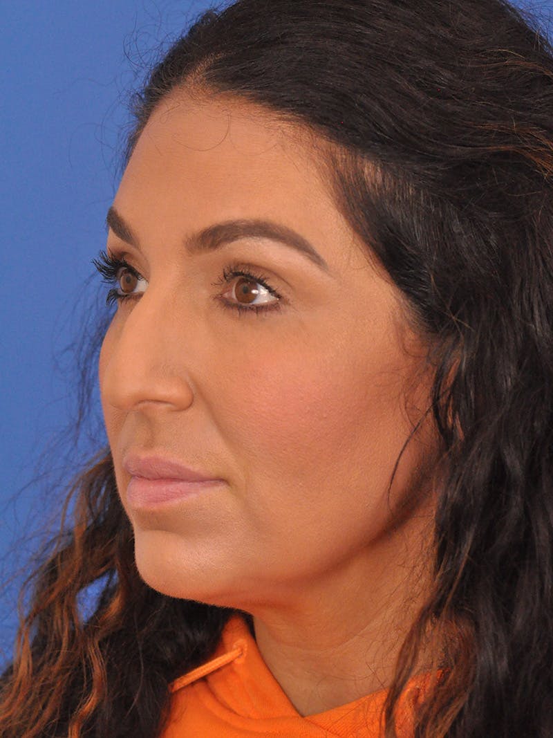 Rhinoplasty Before & After Gallery - Patient 207518 - Image 7