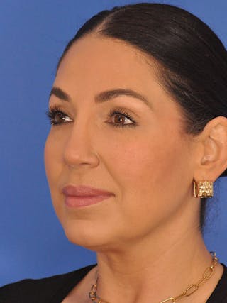 Rhinoplasty Before & After Gallery - Patient 207518 - Image 8