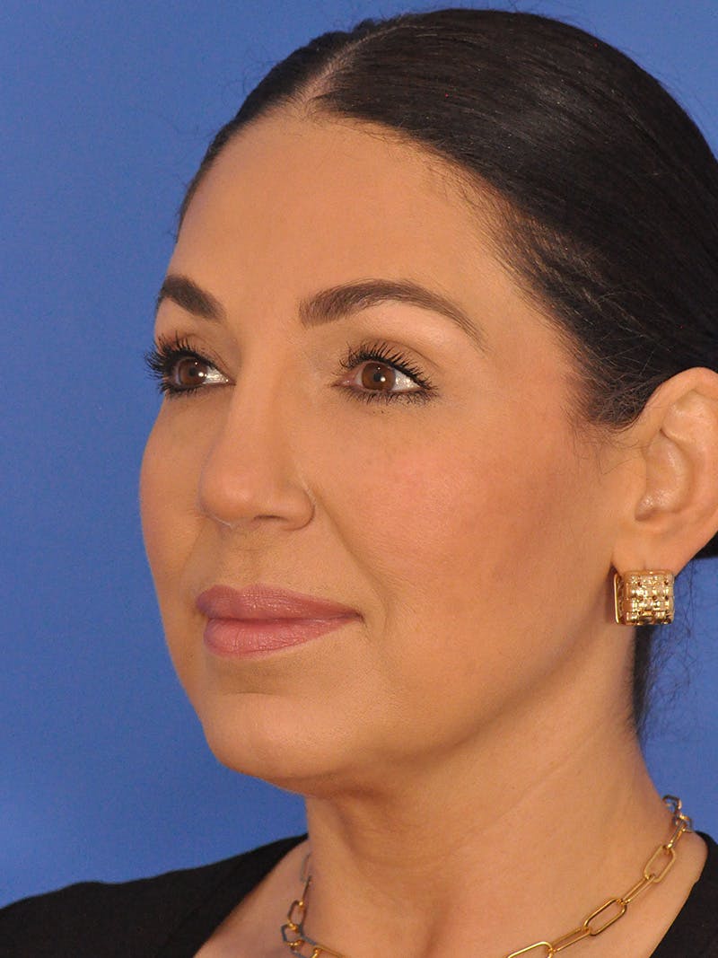 Rhinoplasty Before & After Gallery - Patient 207518 - Image 8