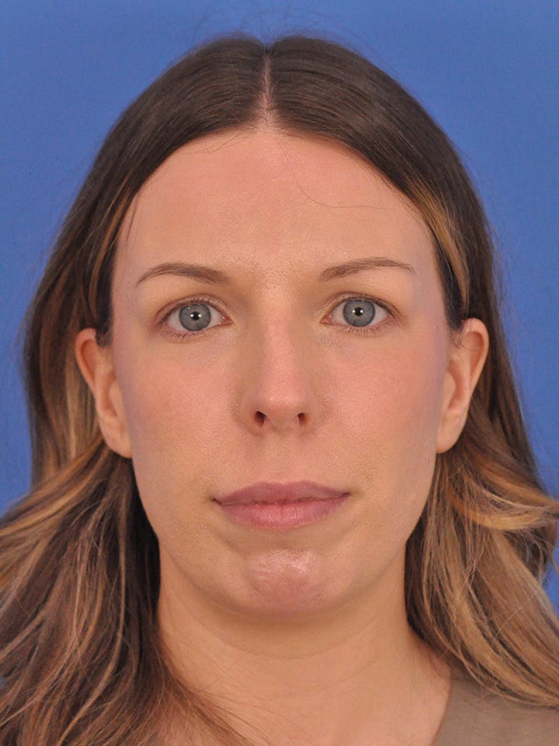 Rhinoplasty Before & After Gallery - Patient 391905 - Image 5