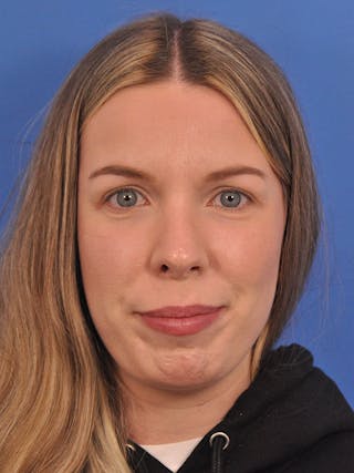 Rhinoplasty Before & After Gallery - Patient 391905 - Image 6