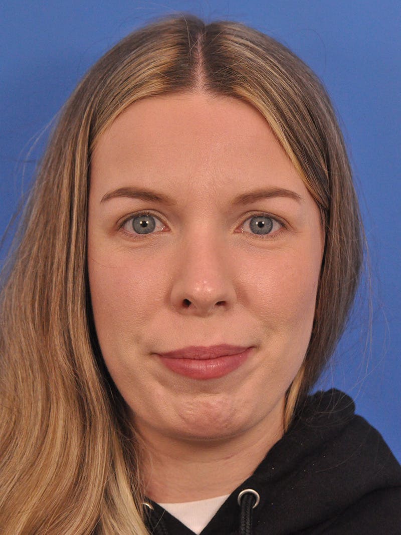 Rhinoplasty Before & After Gallery - Patient 391905 - Image 6