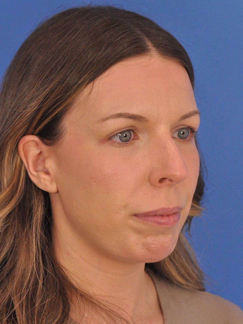Rhinoplasty Before & After Gallery - Patient 391905 - Image 3