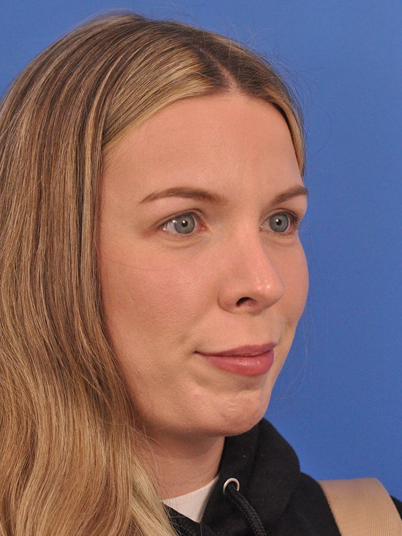 Rhinoplasty Before & After Gallery - Patient 391905 - Image 4