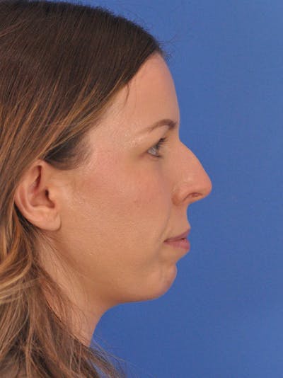 Rhinoplasty Before & After Gallery - Patient 391905 - Image 1