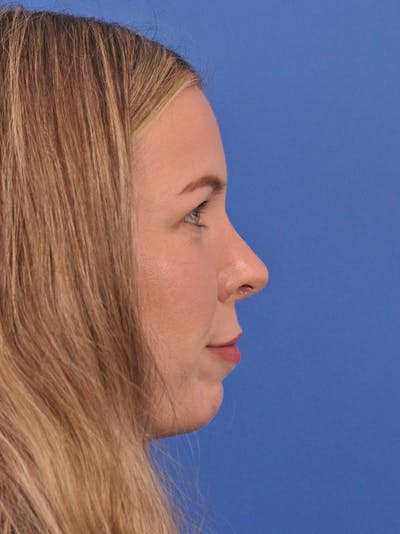Rhinoplasty Before & After Gallery - Patient 391905 - Image 2